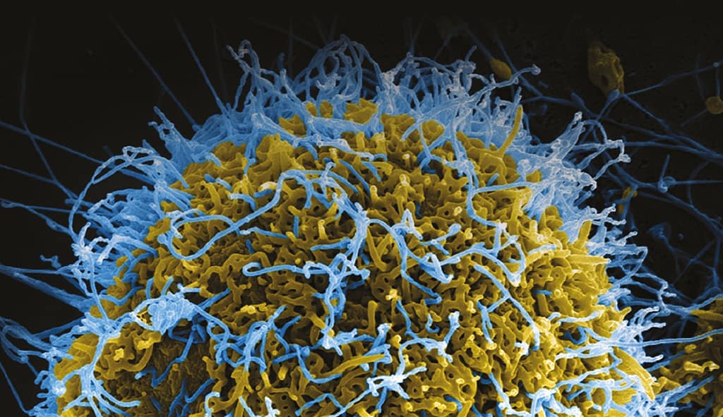 Sarampión: la enfermedad, epidemiología, historia y los programas de vacunación en Chile