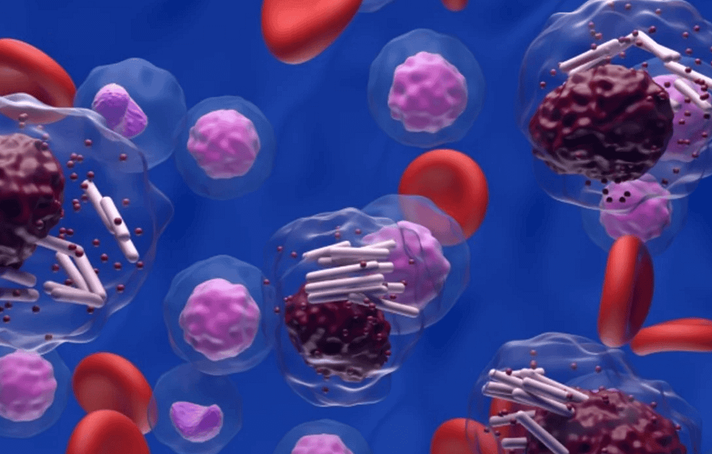 Diagnóstico por citometría de flujo de paciente con leucemia linfoide crónica