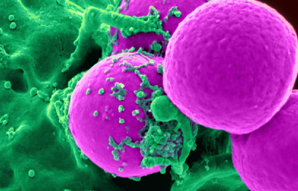 Detección del gen fusión PML-RAR? en pacientes colombianos con leucemia mieloide aguda