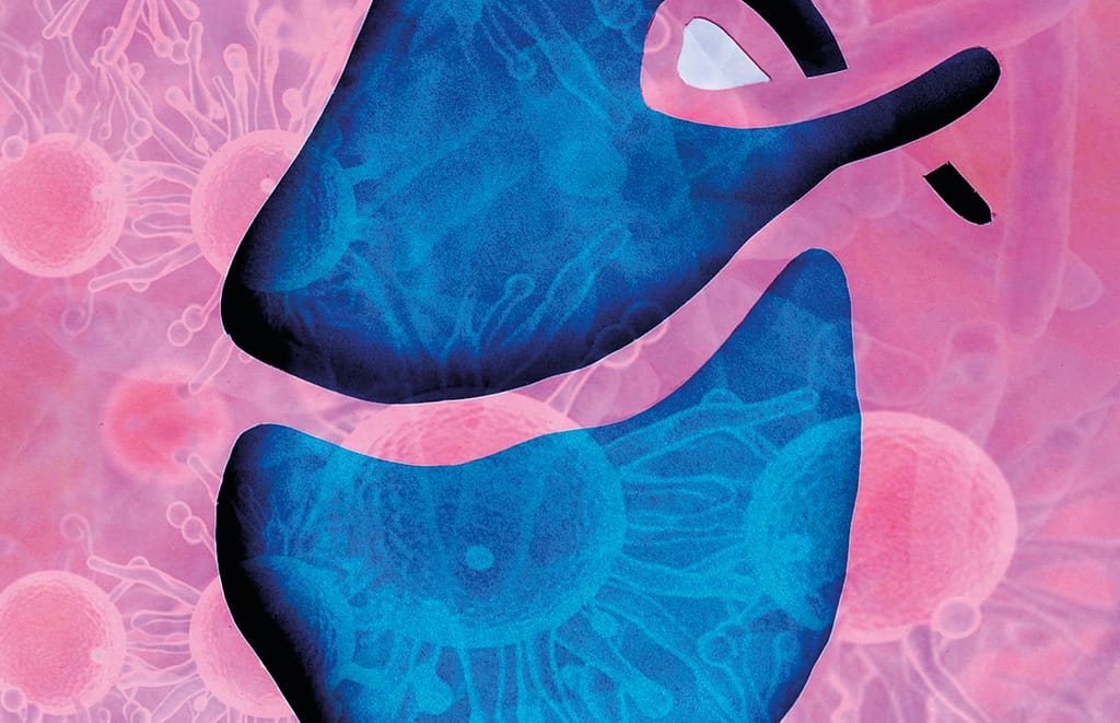 Pericarditis purulenta por Mycobacterium tuberculosis y Streptococcus pneumoniae. Revisión del tema, a propósito de un caso