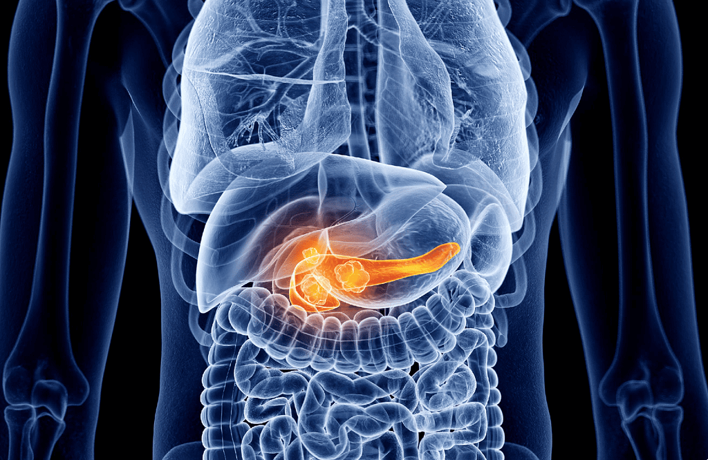 La pancreatitis aguda (PA) inducida por hipertrigliceridemia (HTG) secundaria a déficit de insulina en el contexto de un debut de diabetes mellitus tipo 1 (DM1) es una complicación infrecuente pero grave en niños. 