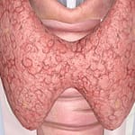 Hipertiroidismo en el embarazo