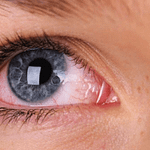 Sífilis ocular como manifestación de neurolues: a propósito de un caso clínico
