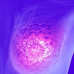 Cáncer de Mama Triple Negativo, otra Enfermedad y Nuevo Reto