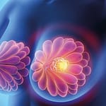 Carcinoma bilateral de mama en crisis visceral