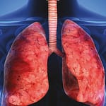 Tuberculosis pleural en un hospital del Noreste Argentino