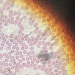 Prevalencia y Causas de Pseudotrombocitopenia en un Hospital de Mendoza