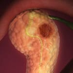 Pancreatitis Aguda: Evidencia Actual