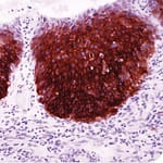 Heat Shock Protein 27 (G3.1) - Stathmin (SP49) Dos nuevos biomarcadores para la identificación de Neoplasia Intraepitelial Cervical (CIN) y Carcinoma Cervical Escamoso (CSC)