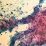 Daño hepatocelular, proteinuria y autoinmunidad: ¿enfermedad multisistémica o coincidencia de enfermedades?