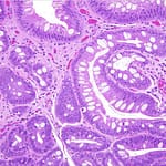 Carcinoma neuroendocrino de esófago: reporte de caso