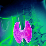 Efectividad de la levotiroxina en el tratamiento del adulto mayor diagnosticado con hipotiroidismo subclínico