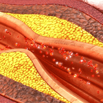 Hipertrigliceridemia severa durante el embarazo