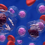 Diagnóstico por citometría de flujo de paciente con leucemia linfoide crónica