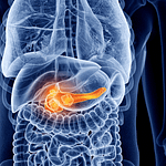 La pancreatitis aguda (PA) inducida por hipertrigliceridemia (HTG) secundaria a déficit de insulina en el contexto de un debut de diabetes mellitus tipo 1 (DM1) es una complicación infrecuente pero grave en niños. 