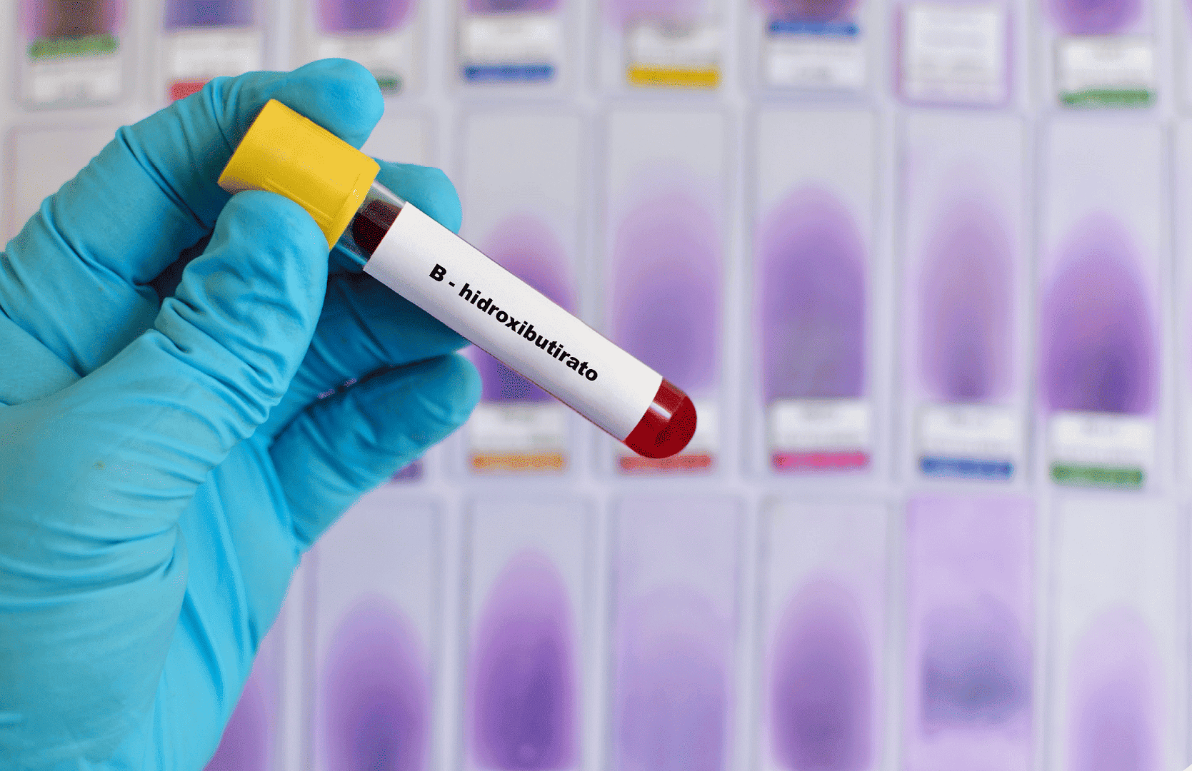 MEDICIÓN DE B-HIDROXIBUTIRATO DIAGNÓSTICO CLAVE PARA TRASTORNOS METABÓLICOS