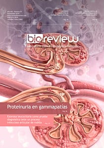 Proteinuria en gammapatías monoclonales