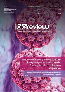 Inmunotinción dual p16INK4a/ki-67 en citología vaginal en medio líquido.