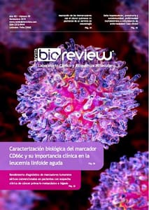 Caracterización biológica del marcador CD66c y su importancia clínica en la leucemia linfoide aguda