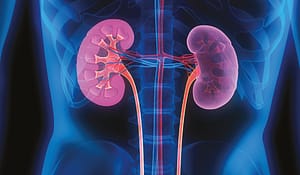 La nefrolitiasis es una de las condiciones urológicas más comunes. La prevalencia durante la vida se estima en 1% a 15%, dependiendo de la edad, género, raza y ubicación geográfica1. El riesgo de sufrir durante la vida un episodio sintomático secundario a litiasis urinaria ha ido en aumento en las últimas décadas, afectando aproximadamente a 10% de la población en países occidentales2. En relación con lo anterior, reportes del hemisferio norte han señalado que este cuadro produce una carga económica mayor a los 5 billones de dólares en gastos directos e indirectos3, estimando incluso que induce un gasto promedio de $3.500 por persona al año4. 