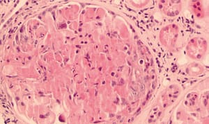 Granulomatosis con poliangeítis: actualización y conceptos claves