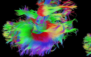 Perfiles clínicos, bioquímicos y moleculares de tres neonatos de Sri Lanka con déficit de piruvato carboxilasa