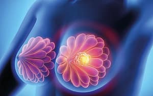 Carcinoma bilateral de mama en crisis visceral
