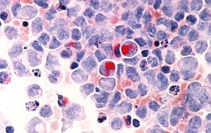 Caracterización de las Leucemias Agudas evaluadas mediante aspirado, biopsia y citometría de flujo en médula ósea durante los años 2012 – 2015, dinámica Ips. Medellín, Colombia