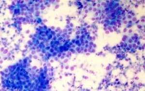 Testosterona y antígeno prostático específico en pacientes portadores de carcinoma prostático, provincia Holguín, 2013-2015