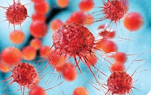 Síndrome de Lynch: selección de pacientes para el estudio genético mediante análisis de inestabilidad microsatelital e inmunohistoquímica