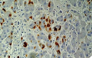 Actualización en el manejo de hepatitis B