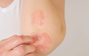 HLA Cw6 como herramienta para el diagnóstico de la Psoriasis