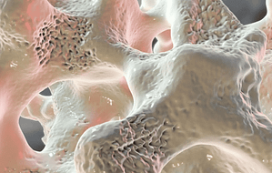 Los análisis de orina en el diagnóstico de las gammapatías monoclonales: puntos de corte