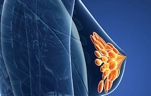 Estudios de patología molecular utilizados para evaluar la amplificación del oncogén HER2 en cáncer de mama. Opinión Clínica