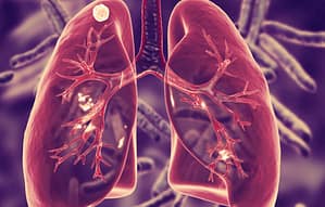 Tuberculosis Meníngea En Un Paciente Pediátrico: Reporte De Un Caso Clínico