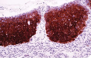Heat Shock Protein 27 (G3.1) - Stathmin (SP49) Dos nuevos biomarcadores para la identificación de Neoplasia Intraepitelial Cervical (CIN) y Carcinoma Cervical Escamoso (CSC)
