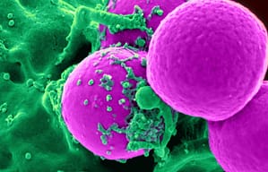 Detección del gen fusión PML-RAR? en pacientes colombianos con leucemia mieloide aguda