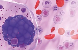 Optimización de flujos de trabajo y paneles de cribado para la detección de gammapatías monoclonales malignas