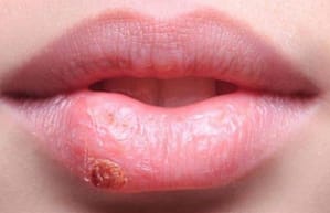 Manifestaciones bucales de enfermedades de transmisión sexual identificadas en tres servicios de estomatología en Sur América