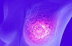 Cáncer de Mama Triple Negativo, otra Enfermedad y Nuevo Reto