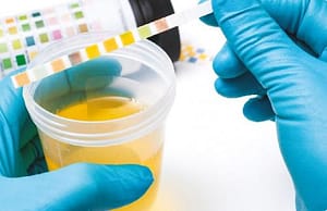 Proteinuria y microalbuminuria