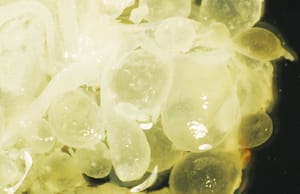 Enfermedad trofoblástica gestacional.