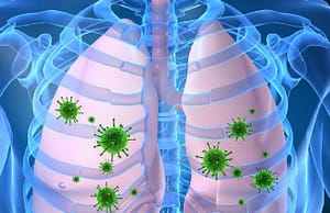 Factores Pronóstico de Neumonía Grave Comunitaria en Unidad de Terapia Intensiva Pediátrica. Bayamo. 2016-2019