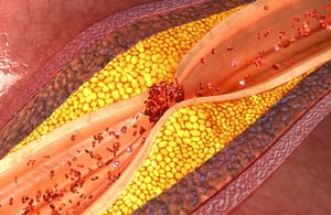 Los triglicéridos y la aterogénesis