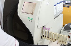 Hemoglobina Glicosilada por HPLC