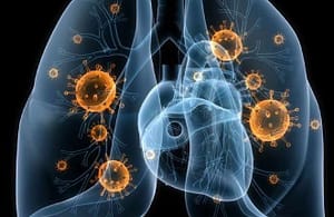 Asociación de los biomarcadores con el cáncer pulmonar en pacientes de un servicio de neumología