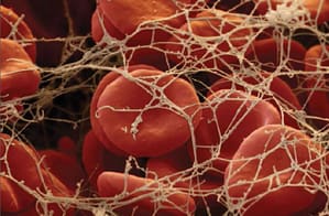 Utilización de los factores de riesgo y modelos clínicos predictivos para el diagnóstico de la enfermedad tromboembólica venosa