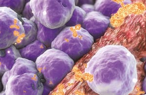 Mutación fundadora en síndrome de Lynch tipo II - CASUÍSTICA