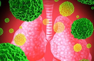 Guía de buenas prácticas clínicas para la atención al niño con neumonía adquirida en la comunidad.