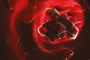 Púrpura trombocitopénica trombótica. Descripción del diagnóstico y manejo de una entidad poco frecuente y de alta mortalidad